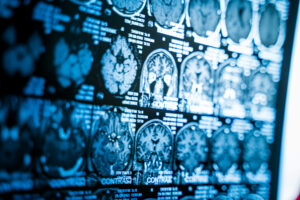 CT scan showing brain and skull injuries after car accident